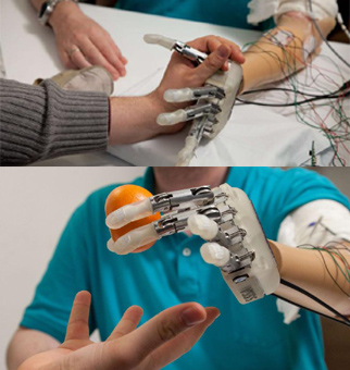prothese bionique de la main
